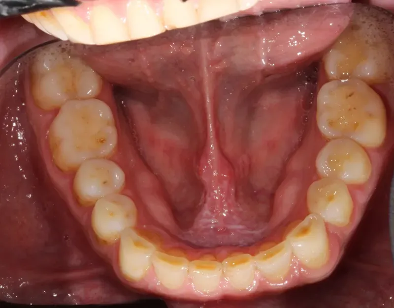 Occlusal view of the mandibular arch, with smooth, rounded posterior cusps and flat, yellowish incisal edges.